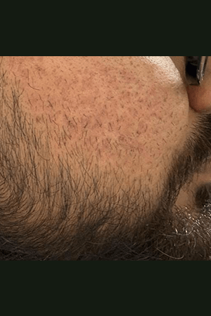 Skin after treatment at Trikaaya