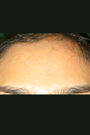 Skin after treatment at Trikaaya