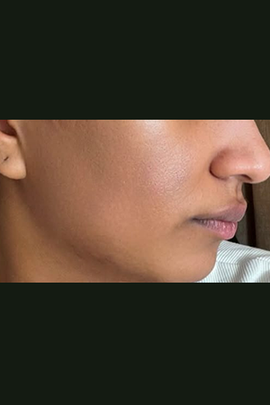 Skin after treatment at Trikaaya